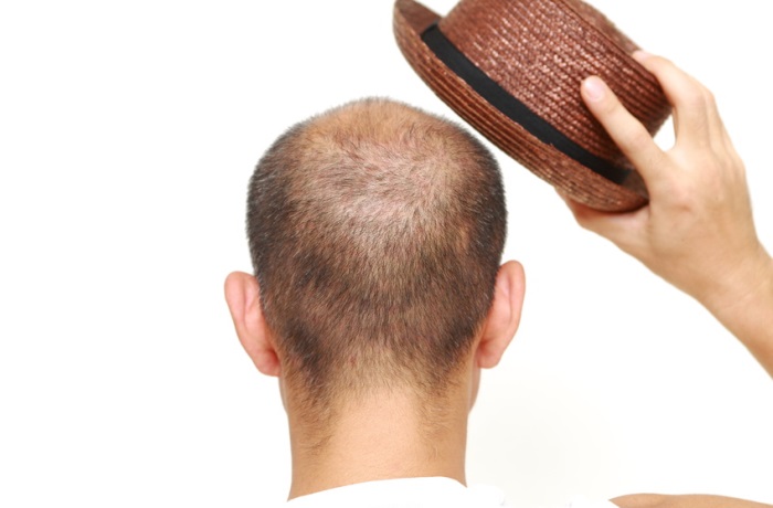 Hut- und Mütze-Tragen sind nicht ausschlaggebend für Haarausfall – vielmehr sind die Probleme vielschichtig und treffen Frauen sowie Männer gleichermaßen