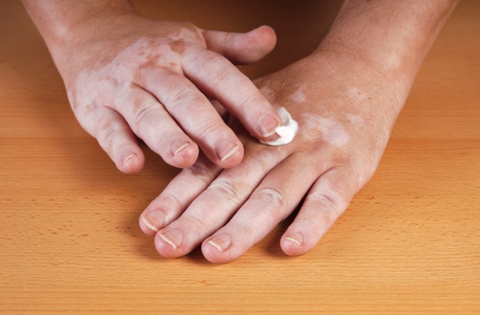 Bei der unheilbaren Autoimmunerkrankung, Vitiligo, auch Weißfleckenkrankheit, leiden die Betroffenen unter sichtbaren Hautauffälligkeiten.