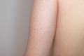 Keratosis pilaris tritt besonders häufig an Armen und Beinen auf und kann vor allem im Sommer kaum verborgen werden.
